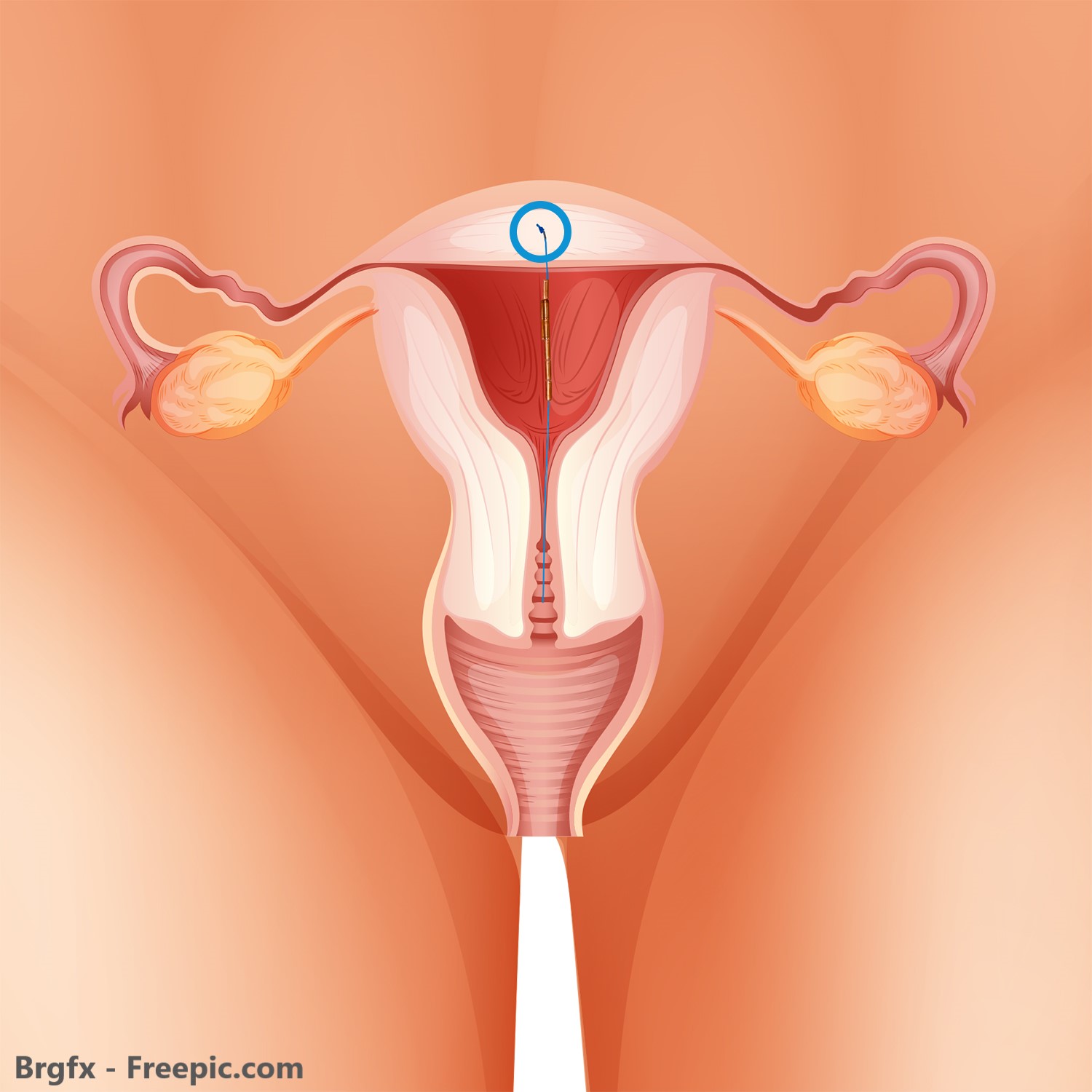 GYN CS Kupfer Spirale in einer Gebärmutter