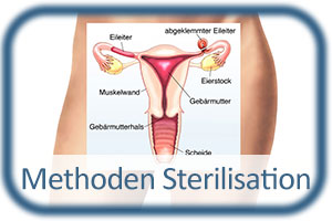 Frau nachteile sterilisation Sterilisation der